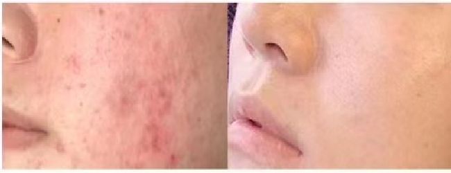 敏感&粉刺&毛孔